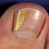 Distal lateral subungual onychomycosis (DLSO)